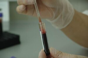 PROVJERITE MUČE LI I VAS: Ovo su simptomi nedostatka željeza u krvi